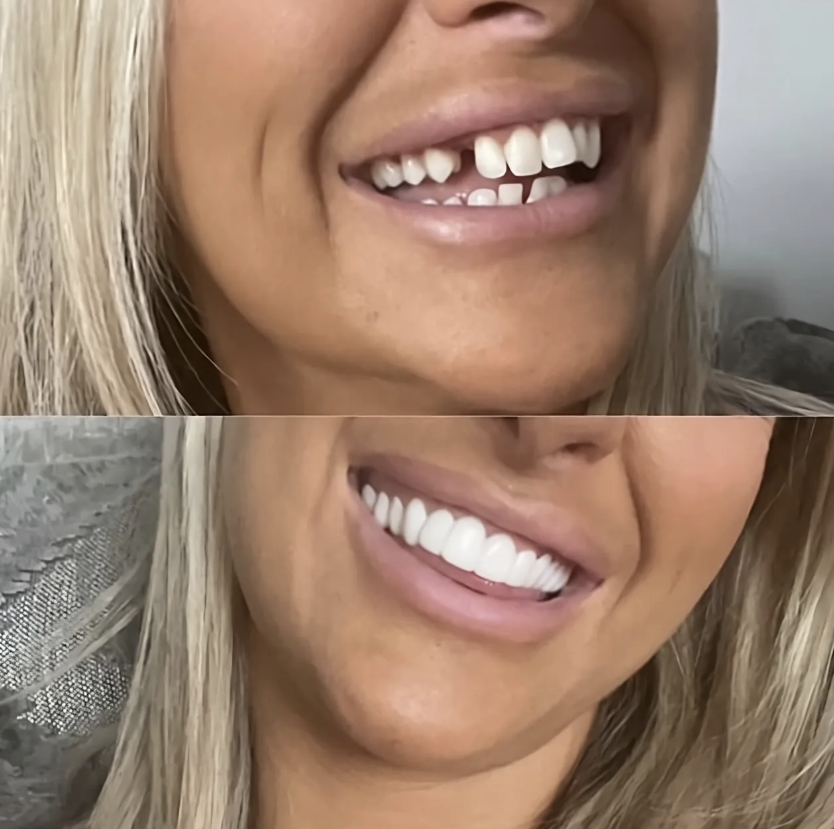 Solai™ Clip-On Veneer